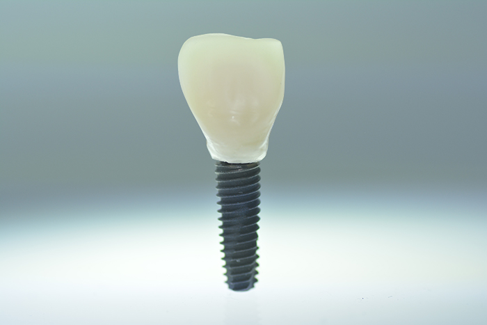 Implantes Dentales